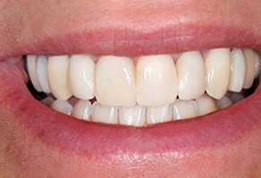 Beautiful healthy smile after restorative dentistry treatment