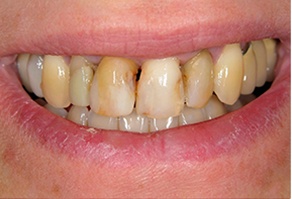 Yellowed and decayed teeth before restorative dentistry treatment