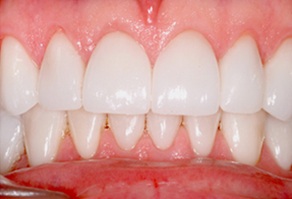Whole healthy smile after dental treatment