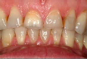 Discolored and worn teeth before dental treatment
