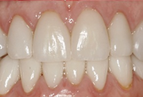 Healthy attractive smile after cosmetic dentistry