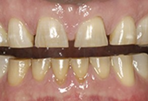 Severely worn teeth before treatment