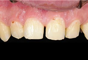 Severe dental decay discoloration and unevenly spaced smile