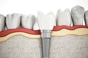 Illustration of dental implant successfully integrated with surrounding bone