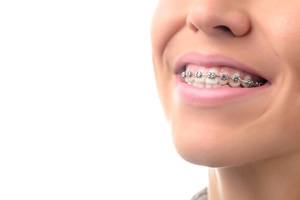 Woman’s smile with professional braces