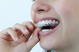 Close-up of woman placing Invisalign tray on her teeth