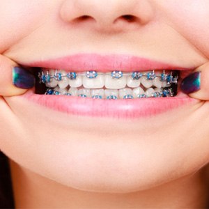 Close-up of girl’s smile with traditional braces in Northborough
