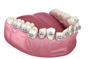 Illustration of traditional braces on crooked dental arch