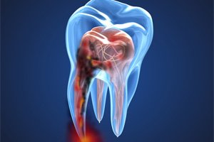 Illustration of infected tooth that may need root canal therapy in Northborough 
