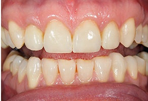 Brilliant white smile after cosmetic dentistry