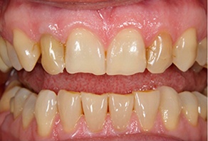 Discolored smile before cosmetic dentistry