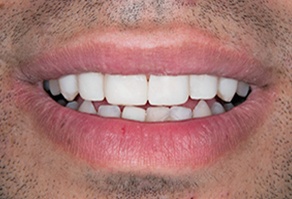 Smile after gap between front teeth is closed