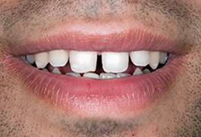 Smile with gap between front teeth