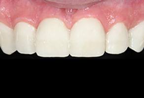 Perfected smile after cosmetic dentistry