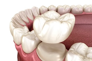 Illustration of CEREC crown being placed on prepared tooth