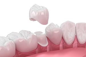 Illustration of dental crown being placed on prepared tooth