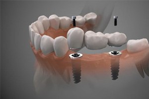 Illustration of three-unit dental implant bridge