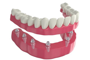 Illustration of implant denture against white background