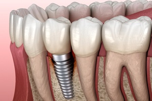 Peri-implantitis, a common cause of dental implant failure