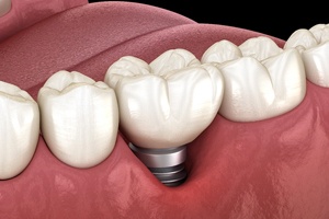 Gums receding around implant, a sign of dental implant failure