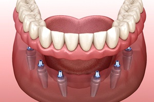 Illustration of fixed implant denture for lower arch