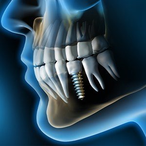 X-ray diagram of dental implants in Northborough