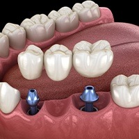 Diagram of an implant bridge replacing multiple missing teeth in Northborough