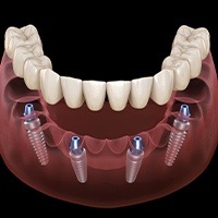 diagram of an implant denture in Northborough