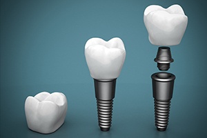 different parts of dental implants in Northborough on blue background