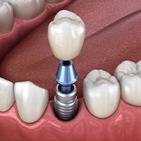Diagram of single tooth dental implant in Northborough
