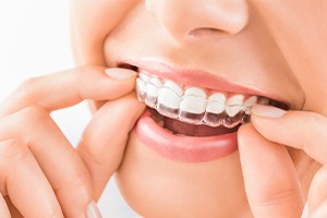 Patient placing Invisalign clear braces tray