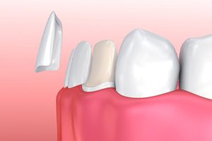 Illustration of porcelain veneer being placed on bottom tooth