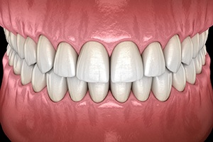 Illustration of healthy teeth after full mouth reconstruction