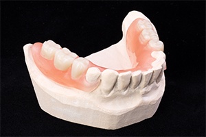 Model smile with partial denture