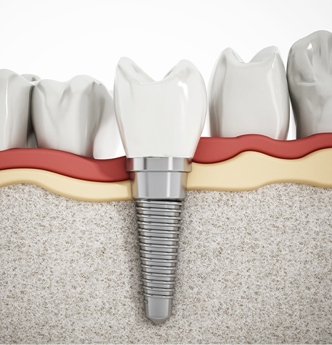 Illustration of dental implant with crown replacing a missing lower tooth