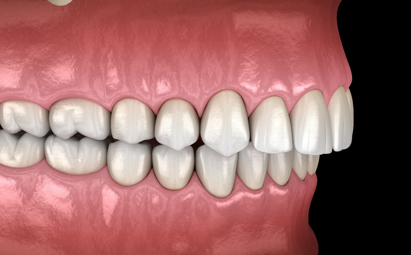 Can Invisalign Fix My Bite Problems can-invisalign-fix-my-bite-problems