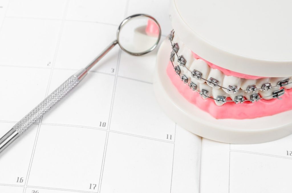 How Long Do Braces Take?