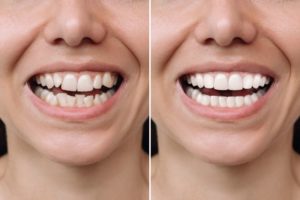 Woman’s smile before and after orthodontic treatment