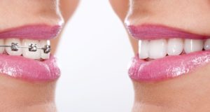 Close-up of woman’s smile with and without braces