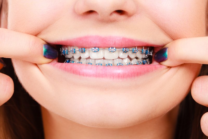 up-close view of a person’s braces
