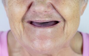 Close-up of toothless senior’s smile